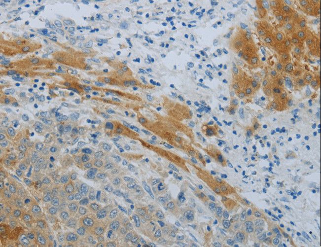 NPHS1 / Nephrin Antibody - Immunohistochemistry of paraffin-embedded Human liver cancer using NPHS1 Polyclonal Antibody at dilution of 1:40.