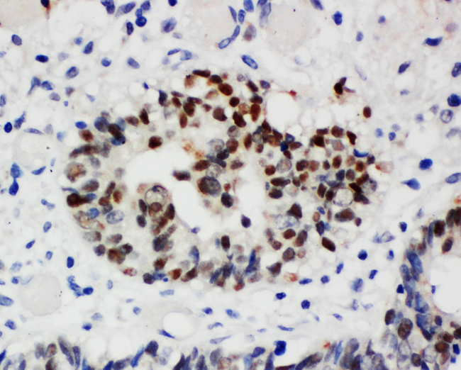 NPM1 / NPM / Nucleophosmin Antibody - NPM1 / NPM / Nucleophosmin antibody. IHC(P): Human Intestinal Cancer Tissue.