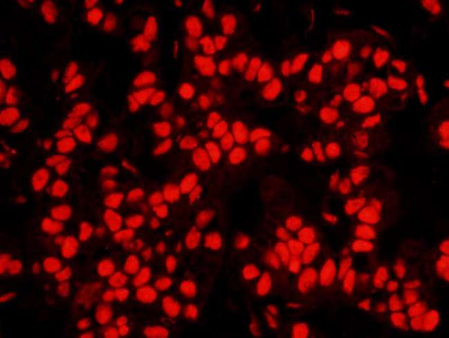 NPM1 / NPM / Nucleophosmin Antibody - Detection of Human NPM1 by Immunohistochemistry. Sample: FFPE section of human breast carcinoma. Antibody: Affinity purified rabbit anti-NPM1 used at a dilution of 1:100. Detection:Red-fluorescent Goat anti-Rabbit IgG-heavy and light chain cross-adsorbed Antibody DyLight 594 Conjugated (A120-601D4) used at a dilution of 1:100.