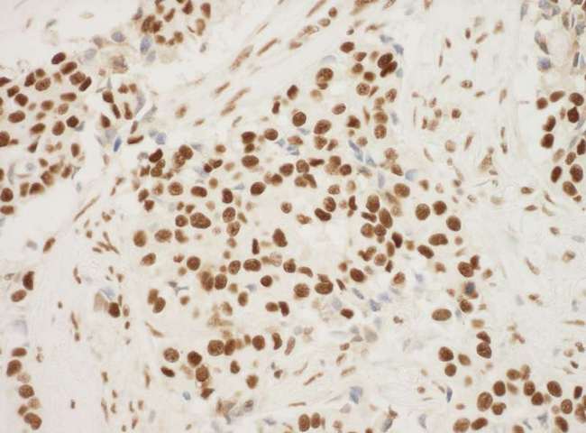 NPM1 / NPM / Nucleophosmin Antibody - Detection of Human NPM1 by Immunohistochemistry. Sample: FFPE section of human breast carcinoma. Antibody: Affinity purified rabbit anti-NPM1 used at a dilution of 1:100.