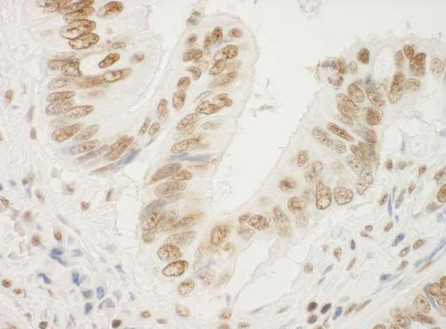 NPM1 / NPM / Nucleophosmin Antibody - Detection of Human NPM1 by Immunohistochemistry. Sample: FFPE section of human colon carcinoma. Antibody: Affinity purified rabbit anti-NPM1 used at a dilution of 1:500.