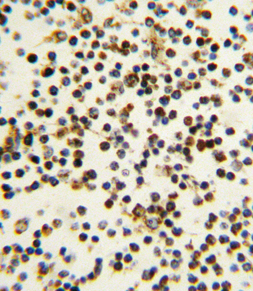 NPM1 / NPM / Nucleophosmin Antibody - Formalin-fixed and paraffin-embedded human lymph tissue reacted with NPM1 antibody , which was peroxidase-conjugated to the secondary antibody, followed by DAB staining. This data demonstrates the use of this antibody for immunohistochemistry; clinical relevance has not been evaluated.