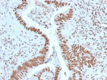 NPM1 / NPM / Nucleophosmin Antibody - IHC staining of FFPE human colon carcinoma with Nucleophosmin antibody. HIER: boil tissue sections in pH6, 10mM citrate buffer, for 10-20 min and allow to cool before testing.