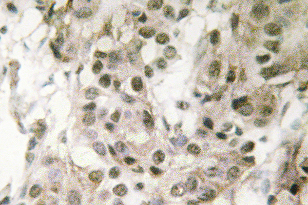 NPM1 / NPM / Nucleophosmin Antibody - IHC of Nucleophosmin (E22) pAb in paraffin-embedded human breast carcinoma tissue.