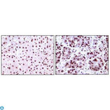 NPM1 / NPM / Nucleophosmin Antibody - Immunohistochemistry (IHC) analysis of paraffin-embedded Human Liver Carcinoma tissues, showing nuclear localization with DAB staining using B23 Monoclonal Antibody.