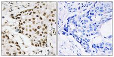 NPM1 / NPM / Nucleophosmin Antibody - Immunohistochemistry analysis of paraffin-embedded human breast carcinoma, using NPM (Phospho-Thr199) Antibody. The picture on the right is blocked with the phospho peptide.