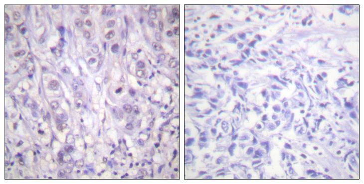 NPM1 / NPM / Nucleophosmin Antibody - P-peptide - + Immunohistochemistry analysis of paraffin-embedded human breast carcinoma tissue using NPM (Phospho-Thr199) antibody.