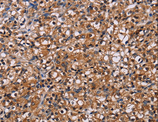 NPM3 Antibody - Immunohistochemistry of paraffin-embedded Human prostate cancer using NPM3 Polyclonal Antibody at dilution of 1:60.