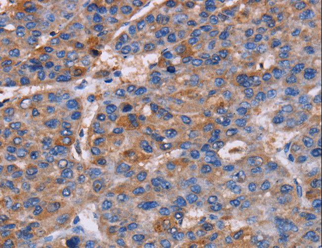 NPM3 Antibody - Immunohistochemistry of paraffin-embedded Human liver cancer using NPM3 Polyclonal Antibody at dilution of 1:60.