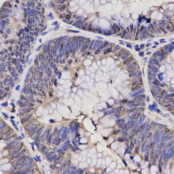 NPPA / ANP Antibody - Immunohistochemistry of paraffin-embedded human rectal cancer using NPPA antibodyat dilution of 1:200 (40x lens).