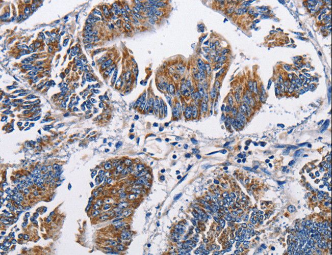 NPPA / ANP Antibody - Immunohistochemistry of paraffin-embedded Human colon cancer using NPPA Polyclonal Antibody at dilution of 1:60.