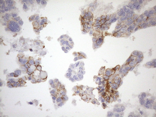NPPB / BNP Antibody - Immunohistochemical staining of paraffin-embedded Adenocarcinoma of Human ovary tissue using anti-NPPB mouse monoclonal antibody. (Heat-induced epitope retrieval by 1mM EDTA in 10mM Tris buffer. (pH8.5) at 120°C for 3 min. (1:150)