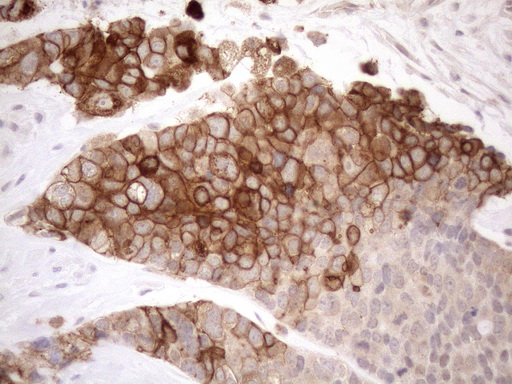 NPPB / BNP Antibody - Immunohistochemical staining of paraffin-embedded Adenocarcinoma of Human endometrium tissue using anti-NPPB mouse monoclonal antibody. (Heat-induced epitope retrieval by 1mM EDTA in 10mM Tris buffer. (pH8.5) at 120°C for 3 min. (1:150)