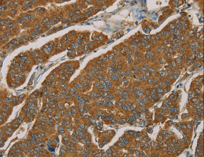 NPPB / BNP Antibody - Immunohistochemistry of paraffin-embedded Human esophagus cancer using NPPB Polyclonal Antibody at dilution of 1:30.