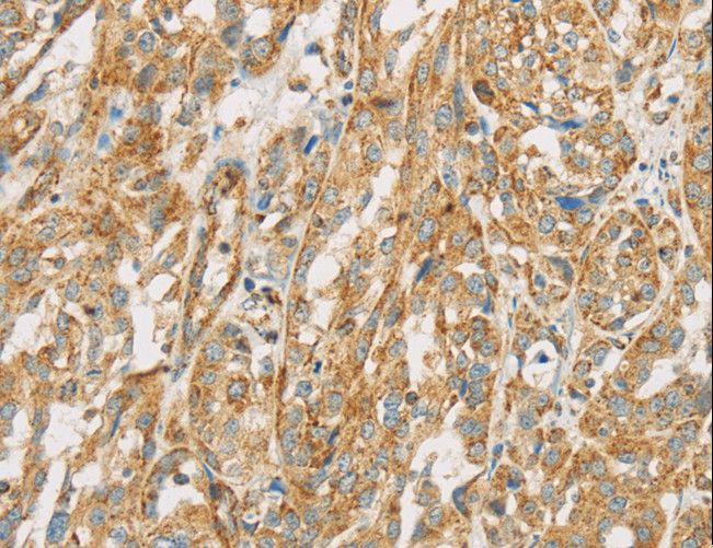 NPPB / BNP Antibody - Immunohistochemistry of paraffin-embedded Human esophagus cancer using NPPB Polyclonal Antibody at dilution of 1:30.