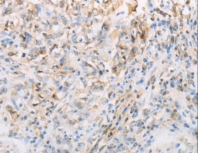 NPPC Antibody - Immunohistochemistry of paraffin-embedded Human gastric cancer using NPPC Polyclonal Antibody at dilution of 1:70.