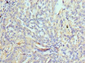 NPR2L / TUSC4 Antibody - Immunohistochemistry of paraffin-embedded human lung cancer using antibody at 1:100 dilution.