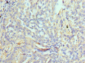 NPR2L / TUSC4 Antibody - Immunohistochemistry of paraffin-embedded human lung cancer using NPRL2 Antibody at dilution of 1:100