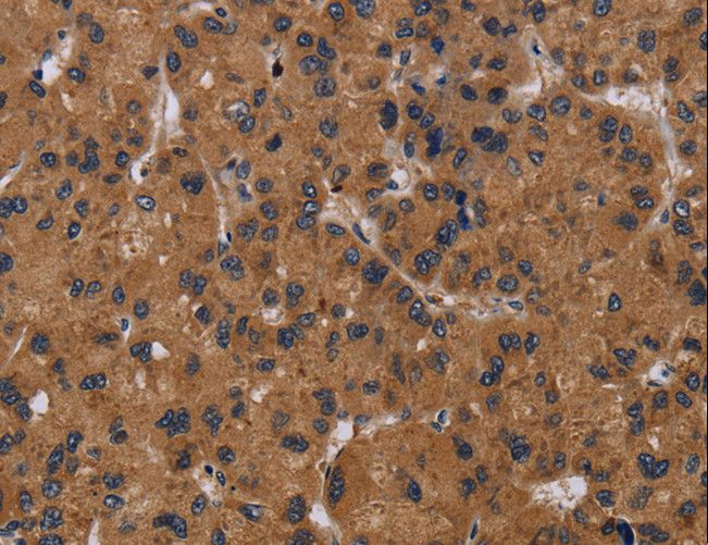 NPR2L / TUSC4 Antibody - Immunohistochemistry of paraffin-embedded Human thyroid cancer using NPRL2 Polyclonal Antibody at dilution of 1:50.