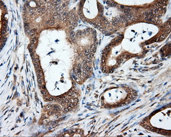 NPR3 Antibody - IHC of paraffin-embedded Adenocarcinoma of colon tissue using anti- mouse monoclonal antibody. (Dilution 1:50).