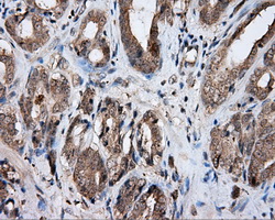 NPR3 Antibody - Immunohistochemical staining of paraffin-embedded Carcinoma of prostate tissue using anti- mouse monoclonal antibody. (Dilution 1:50).