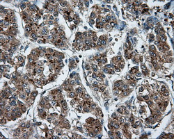 NPR3 Antibody - IHC of paraffin-embedded Carcinoma of liver tissue using anti-NPR3 mouse monoclonal antibody. (Dilution 1:50).