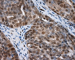 NPR3 Antibody - IHC of paraffin-embedded Adenocarcinoma of ovary tissue using anti-NPR3 mouse monoclonal antibody. (Dilution 1:50).