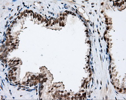 NPR3 Antibody - IHC of paraffin-embedded Carcinoma of prostate tissue using anti-NPR3 mouse monoclonal antibody. (Dilution 1:50).