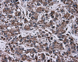 NPR3 Antibody - IHC of paraffin-embedded Carcinoma of liver tissue using anti- mouse monoclonal antibody. (Dilution 1:50).