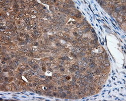 NPR3 Antibody - Immunohistochemical staining of paraffin-embedded Adenocarcinoma of ovary tissue using anti- mouse monoclonal antibody. (Dilution 1:50).