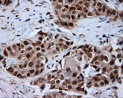 NPR3 Antibody - IHC of paraffin-embedded Adenocarcinoma of breast tissue using anti- mouse monoclonal antibody. (Dilution 1:50).