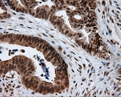 NPR3 Antibody - IHC of paraffin-embedded Adenocarcinoma of colon tissue using anti- mouse monoclonal antibody. (Dilution 1:50).