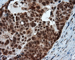 NPR3 Antibody - IHC of paraffin-embedded Adenocarcinoma of ovary tissue using anti- mouse monoclonal antibody. (Dilution 1:50).
