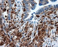 NPR3 Antibody - Immunohistochemical staining of paraffin-embedded Adenocarcinoma of colon tissue using anti- mouse monoclonal antibody. (Dilution 1:50).
