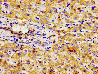 NPR3 Antibody - Immunohistochemistry image of paraffin-embedded human liver cancer at a dilution of 1:100