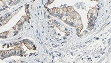 NPRA / NPR1 Antibody - 1:100 staining human prostate tissue by IHC-P. The sample was formaldehyde fixed and a heat mediated antigen retrieval step in citrate buffer was performed. The sample was then blocked and incubated with the antibody for 1.5 hours at 22°C. An HRP conjugated goat anti-rabbit antibody was used as the secondary.