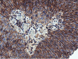 NPTN / SDR1 Antibody - IHC of paraffin-embedded Carcinoma of Human bladder tissue using anti-NPTN mouse monoclonal antibody. (Heat-induced epitope retrieval by 10mM citric buffer, pH6.0, 100C for 10min).