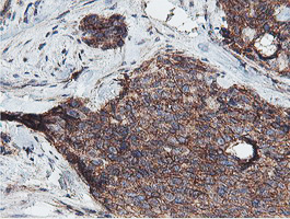 NPTN / SDR1 Antibody - IHC of paraffin-embedded Adenocarcinoma of Human breast tissue using anti-NPTN mouse monoclonal antibody. (Heat-induced epitope retrieval by 10mM citric buffer, pH6.0, 100C for 10min).