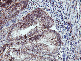 NPTN / SDR1 Antibody - IHC of paraffin-embedded Adenocarcinoma of Human endometrium tissue using anti-NPTN mouse monoclonal antibody. (Heat-induced epitope retrieval by 10mM citric buffer, pH6.0, 100C for 10min).