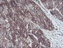 NPTN / SDR1 Antibody - IHC of paraffin-embedded Adenocarcinoma of Human ovary tissue using anti-NPTN mouse monoclonal antibody.