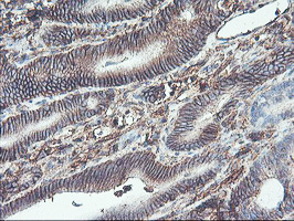 NPTN / SDR1 Antibody - IHC of paraffin-embedded Carcinoma of Human pancreas tissue using anti-NPTN mouse monoclonal antibody.