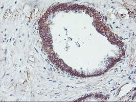 NPTN / SDR1 Antibody - IHC of paraffin-embedded Carcinoma of Human prostate tissue using anti-NPTN mouse monoclonal antibody.