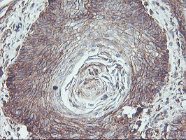 NPTN / SDR1 Antibody - IHC of paraffin-embedded Carcinoma of Human bladder tissue using anti-NPTN mouse monoclonal antibody.