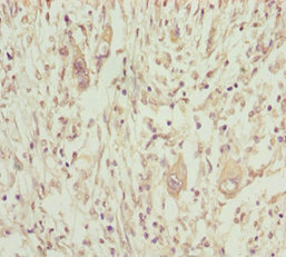 NPTN / SDR1 Antibody - Immunohistochemistry of paraffin-embedded human pancreatic cancer at dilution 1:100