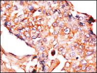 NPTX1 Antibody - Formalin-fixed and paraffin-embedded human breast carcinoma reacted with anti-NP1(Nptx1) Antibody , which was peroxidase-conjugated to the secondary antibody, followed by DAB staining. This data demonstrates the use of this antibody for immunohistochemistry; clinical relevance has not been evaluated.