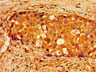 NPTX1 Antibody - Immunohistochemistry image of paraffin-embedded human breast cancer at a dilution of 1:100