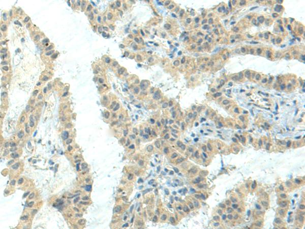 NPVF Antibody - Immunohistochemistry of paraffin-embedded Human thyroid cancer tissue  using NPVF Polyclonal Antibody at dilution of 1:80(×200)