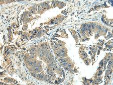 NPVF Antibody - Immunohistochemistry of paraffin-embedded Human colorectal cancer tissue  using NPVF Polyclonal Antibody at dilution of 1:65(×200)