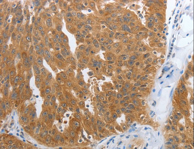 NPY1R Antibody - Immunohistochemistry of paraffin-embedded Human ovarian cancer using NPY1R Polyclonal Antibody at dilution of 1:25.