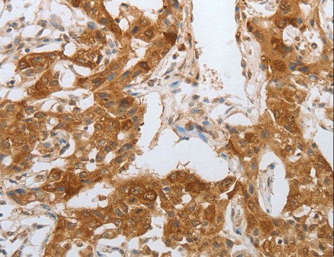 NPY1R Antibody - Immunohistochemistry of paraffin-embedded Human lung cancer using NPY1R Polyclonal Antibody at dilution of 1:25.